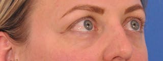 Blepharoplasty Before & After Gallery - Patient 414762 - Image 4