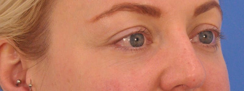 Blepharoplasty Before & After Gallery - Patient 414762 - Image 3