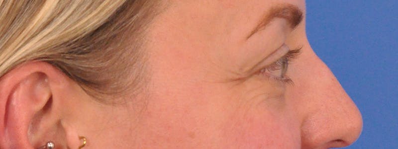 Blepharoplasty Before & After Gallery - Patient 414762 - Image 6