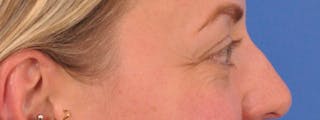 Blepharoplasty Before & After Gallery - Patient 414762 - Image 6