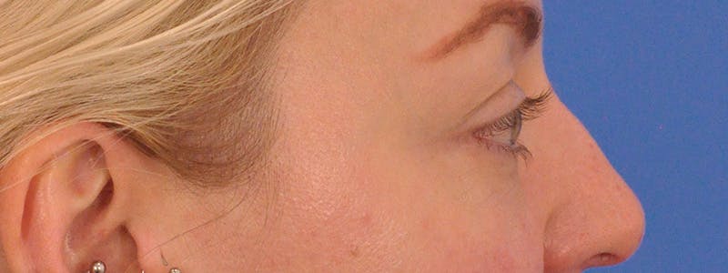 Blepharoplasty Before & After Gallery - Patient 414762 - Image 5