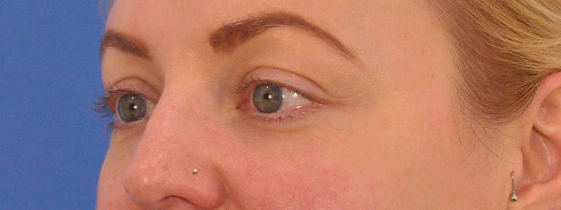 Blepharoplasty Before & After Gallery - Patient 414762 - Image 7