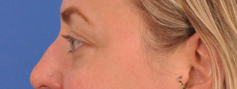 Blepharoplasty Before & After Gallery - Patient 414762 - Image 10