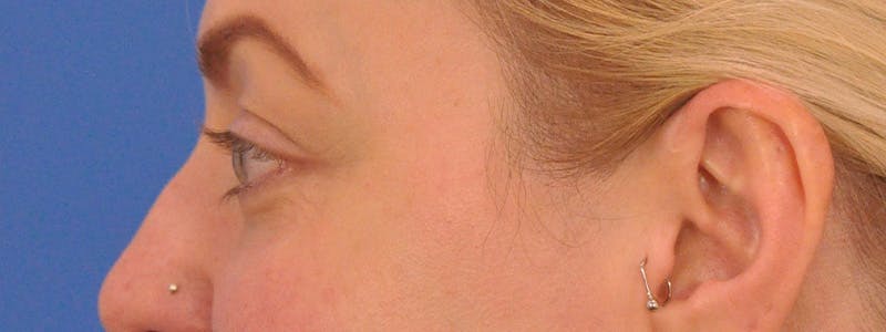 Blepharoplasty Before & After Gallery - Patient 414762 - Image 9