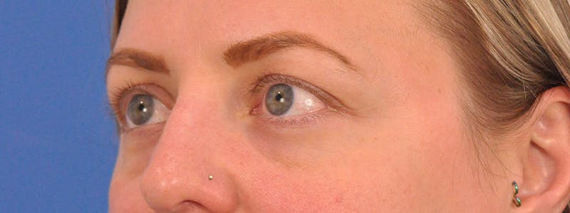 Blepharoplasty Before & After Gallery - Patient 414762 - Image 8