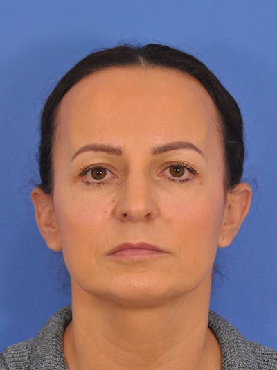 Facelift Before & After Gallery - Patient 651967 - Image 2