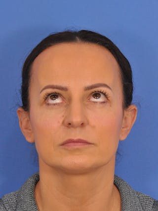 CO2RE Laser Before & After Gallery - Patient 393896 - Image 4