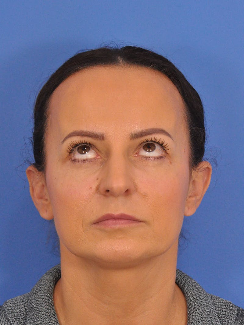 CO2RE Laser Before & After Gallery - Patient 393896 - Image 4