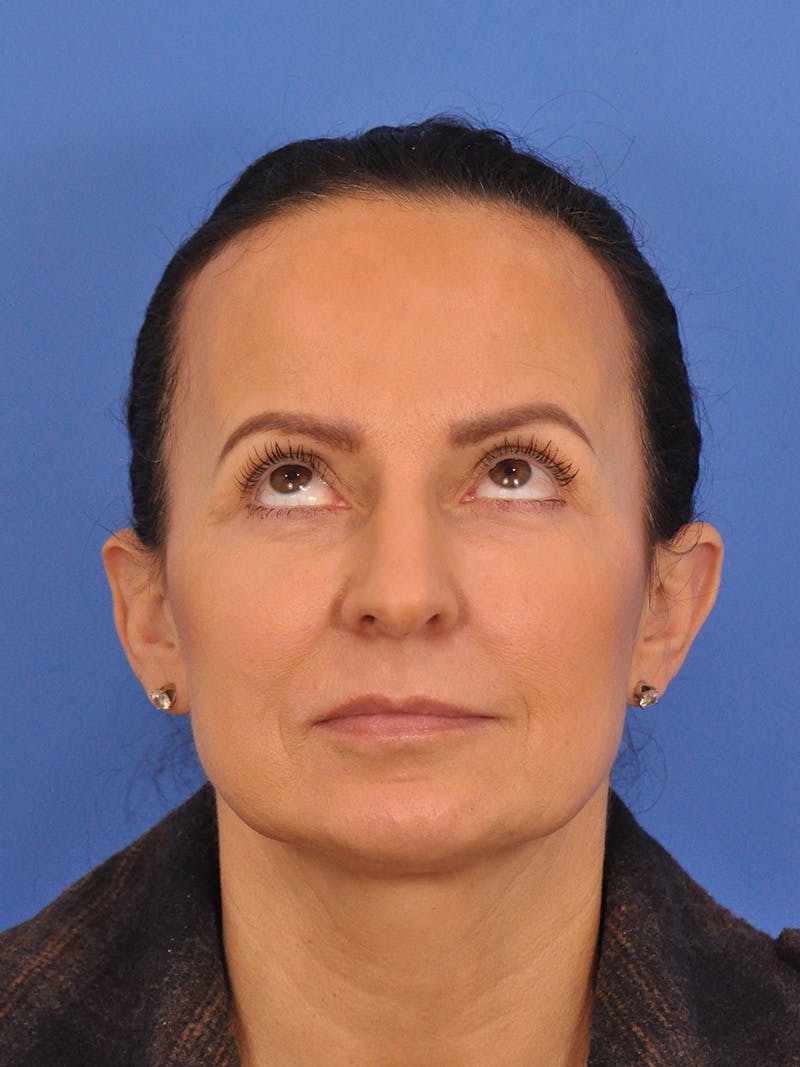 CO2RE Laser Before & After Gallery - Patient 393896 - Image 3