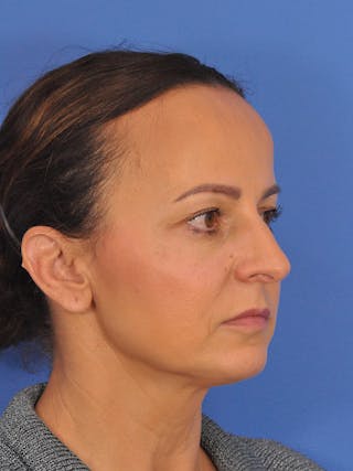 CO2RE Laser Before & After Gallery - Patient 393896 - Image 6
