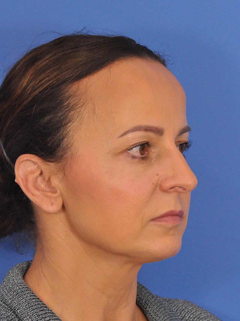CO2RE Laser Before & After Gallery - Patient 393896 - Image 6