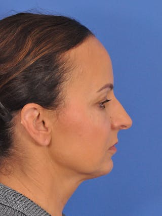 CO2RE Laser Before & After Gallery - Patient 393896 - Image 8