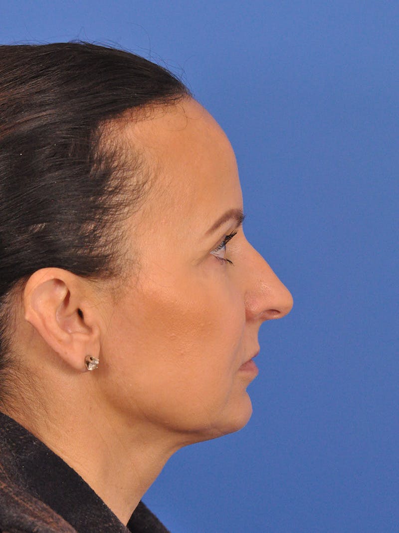 CO2RE Laser Before & After Gallery - Patient 393896 - Image 7