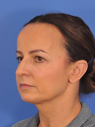 CO2RE Laser Before & After Gallery - Patient 393896 - Image 10