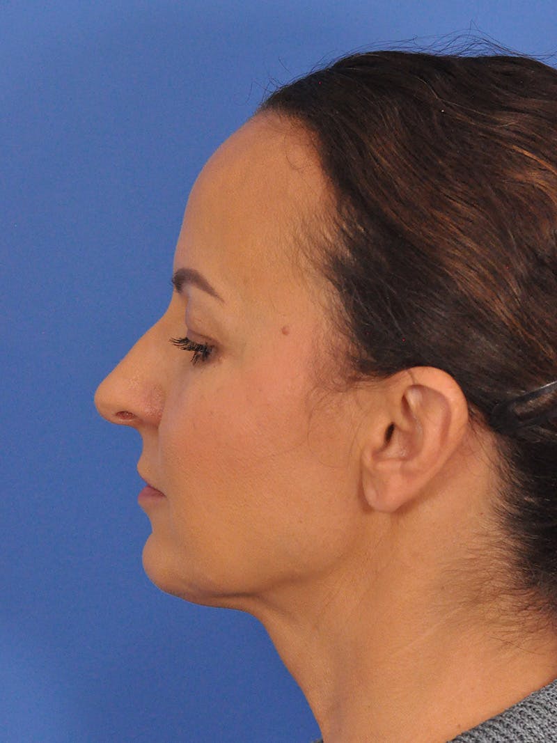CO2RE Laser Before & After Gallery - Patient 393896 - Image 12
