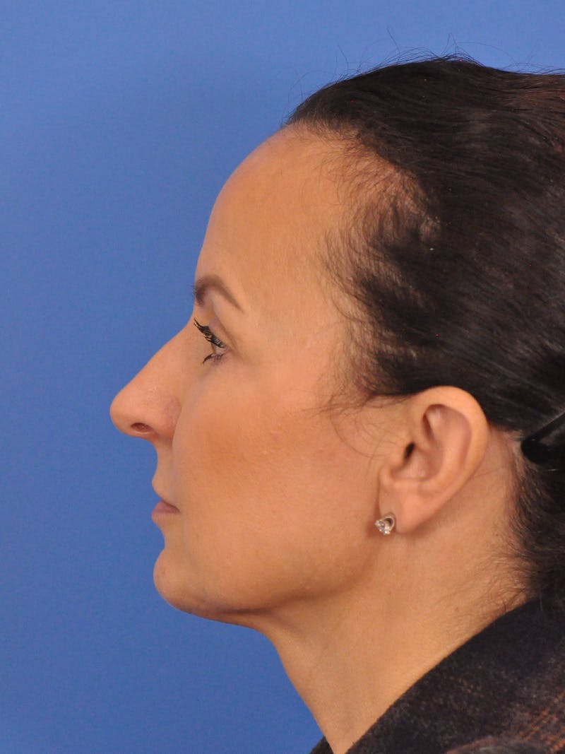 CO2RE Laser Before & After Gallery - Patient 393896 - Image 11