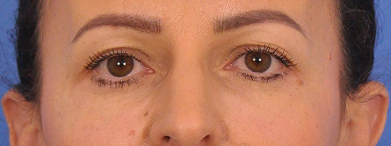 Blepharoplasty Before & After Gallery - Patient 148824 - Image 3