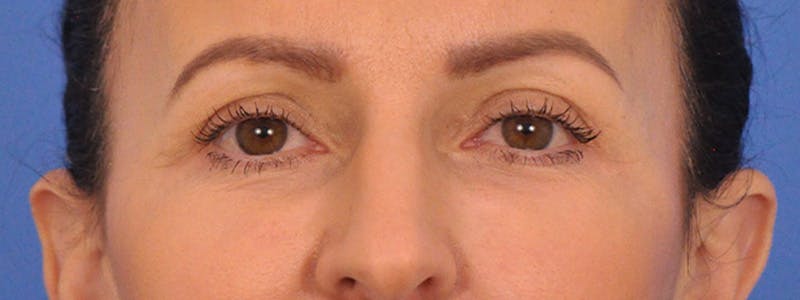 Blepharoplasty Before & After Gallery - Patient 148824 - Image 4