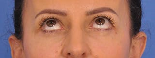 Blepharoplasty Before & After Gallery - Patient 148824 - Image 2