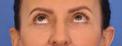 Blepharoplasty Before & After Gallery - Patient 148824 - Image 1