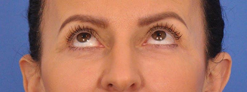 Blepharoplasty Before & After Gallery - Patient 148824 - Image 1
