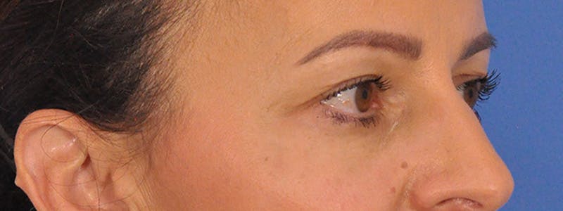 Blepharoplasty Before & After Gallery - Patient 148824 - Image 5