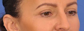 Blepharoplasty Before & After Gallery - Patient 148824 - Image 6