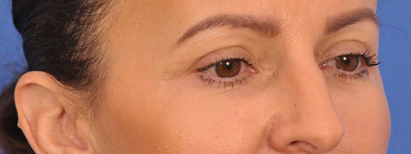 Blepharoplasty Before & After Gallery - Patient 148824 - Image 6
