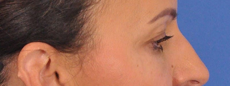 Blepharoplasty Before & After Gallery - Patient 148824 - Image 7