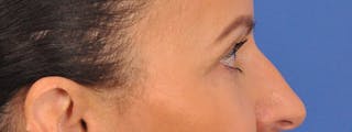 Blepharoplasty Before & After Gallery - Patient 148824 - Image 8