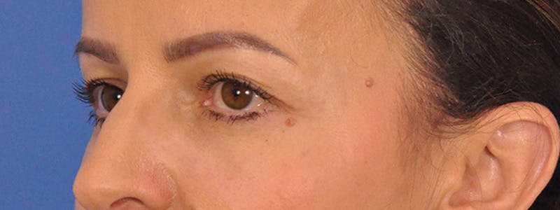 Blepharoplasty Before & After Gallery - Patient 148824 - Image 9