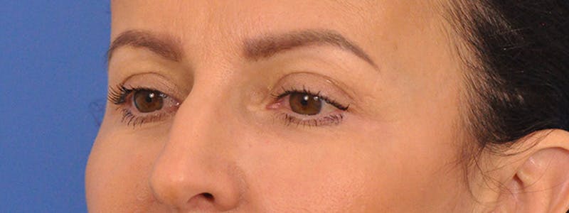 Blepharoplasty Before & After Gallery - Patient 148824 - Image 10