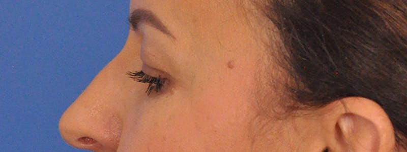 Blepharoplasty Before & After Gallery - Patient 148824 - Image 11