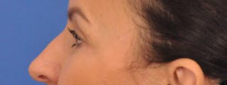Blepharoplasty Before & After Gallery - Patient 148824 - Image 12