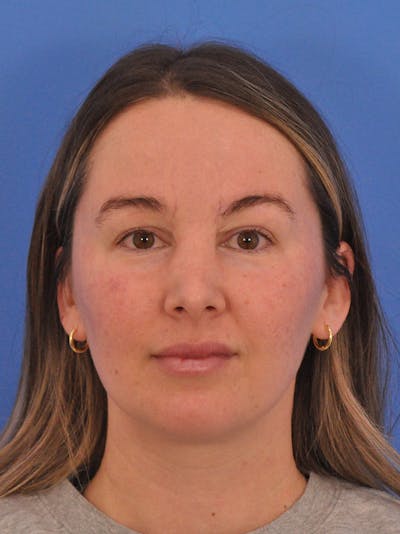 Vbeam Laser Before & After Gallery - Patient 137027 - Image 2
