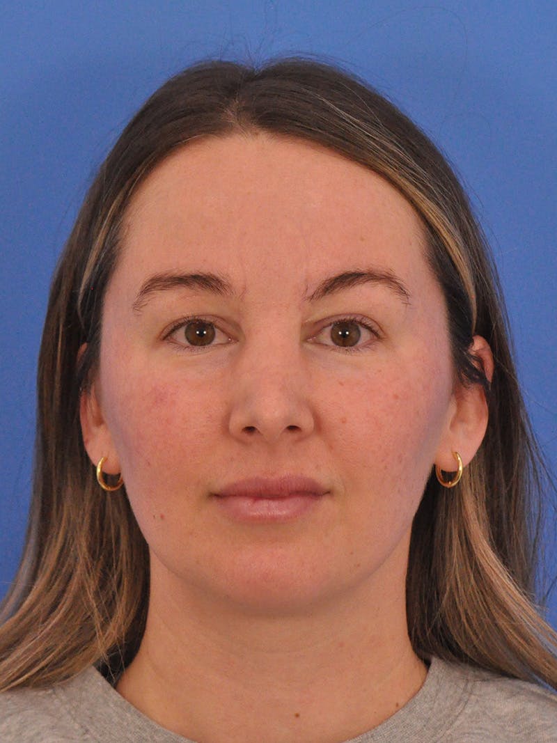 Vbeam Laser Before & After Gallery - Patient 137027 - Image 2