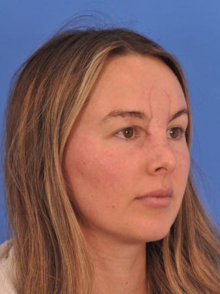 Vbeam Laser Before & After Gallery - Patient 137027 - Image 4