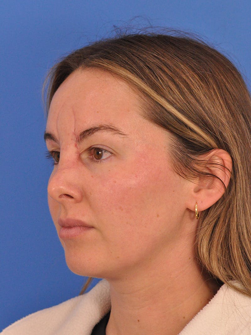 Vbeam Laser Before & After Gallery - Patient 137027 - Image 7