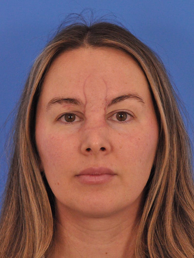 Vbeam Laser Before & After Gallery - Patient 137027 - Image 1