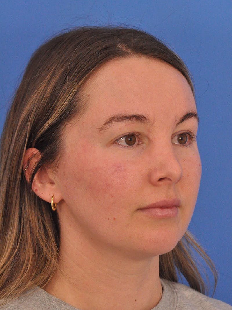Vbeam Laser Before & After Gallery - Patient 137027 - Image 3