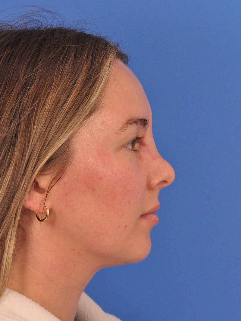 Vbeam Laser Before & After Gallery - Patient 137027 - Image 5