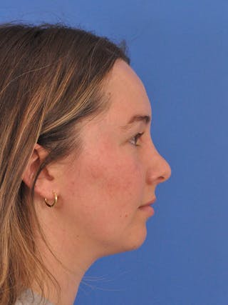 Vbeam Laser Before & After Gallery - Patient 137027 - Image 6