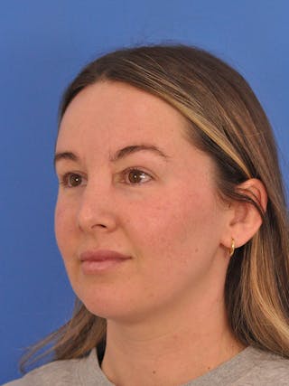 Vbeam Laser Before & After Gallery - Patient 137027 - Image 8
