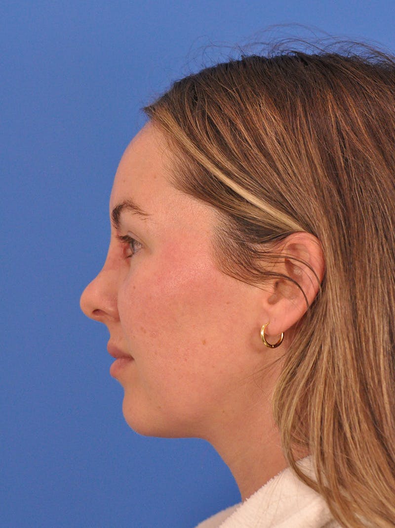Vbeam Laser Before & After Gallery - Patient 137027 - Image 9