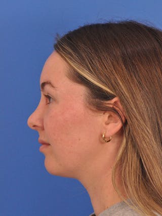 Vbeam Laser Before & After Gallery - Patient 137027 - Image 10