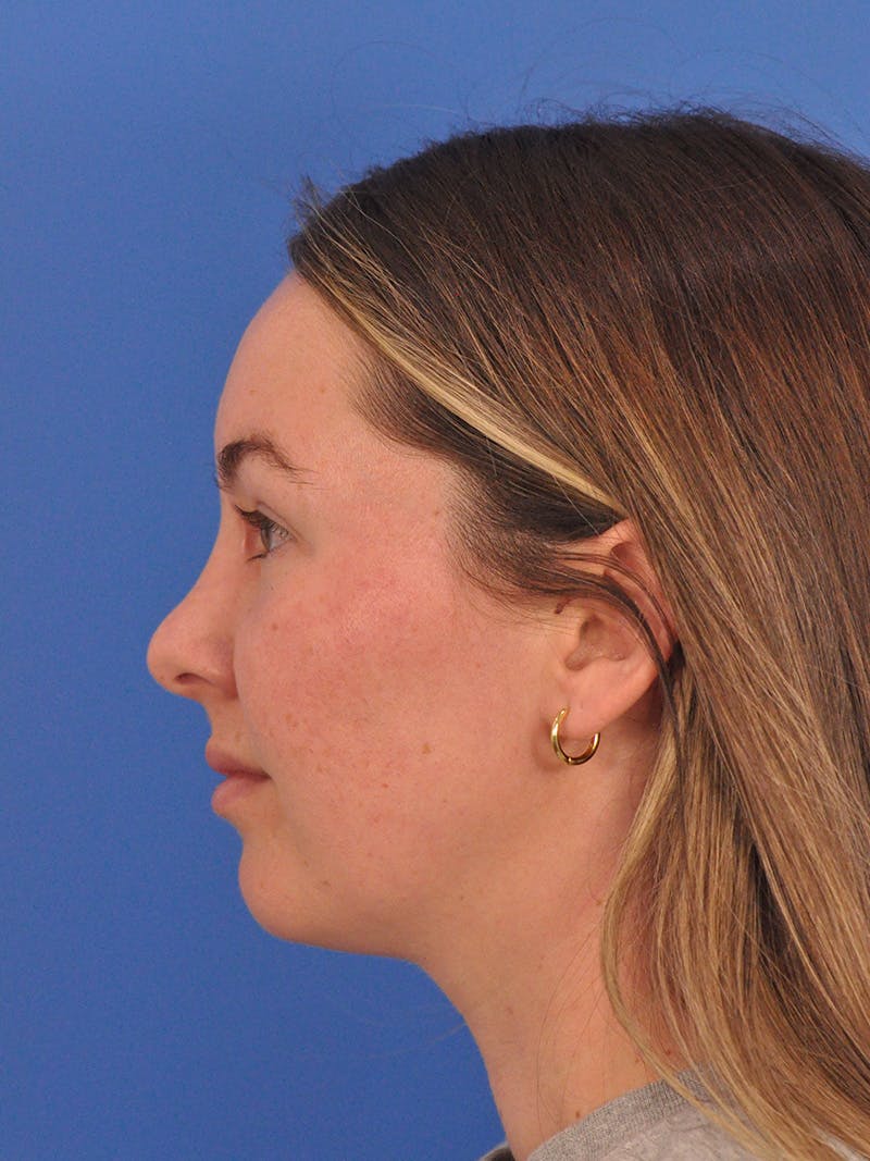 Vbeam Laser Before & After Gallery - Patient 137027 - Image 10