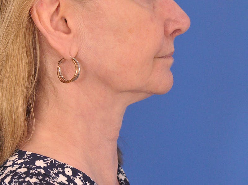CO2RE Laser Before & After Gallery - Patient 106102 - Image 5