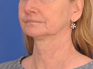 CO2RE Laser Before & After Gallery - Patient 106102 - Image 8