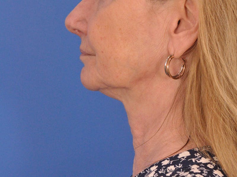 CO2RE Laser Before & After Gallery - Patient 106102 - Image 9