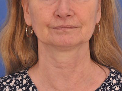CO2RE Laser Before & After Gallery - Patient 106102 - Image 1